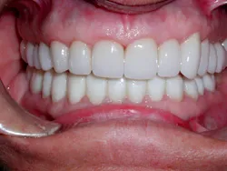 Metal Free Crowns - After